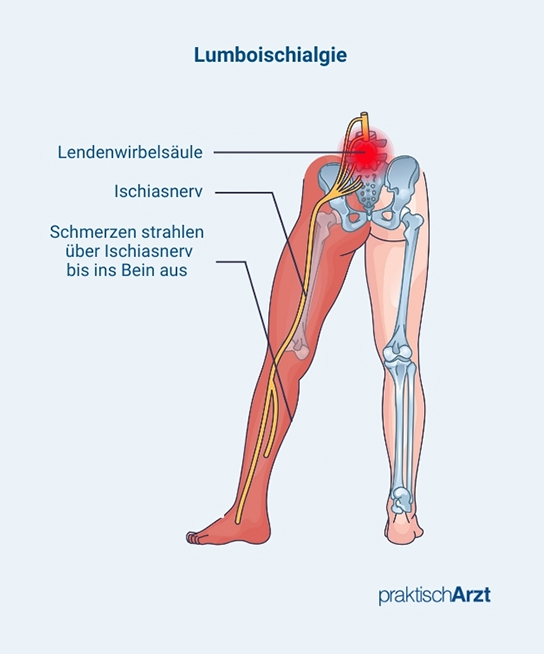 Lumboischialgie Schmerzen